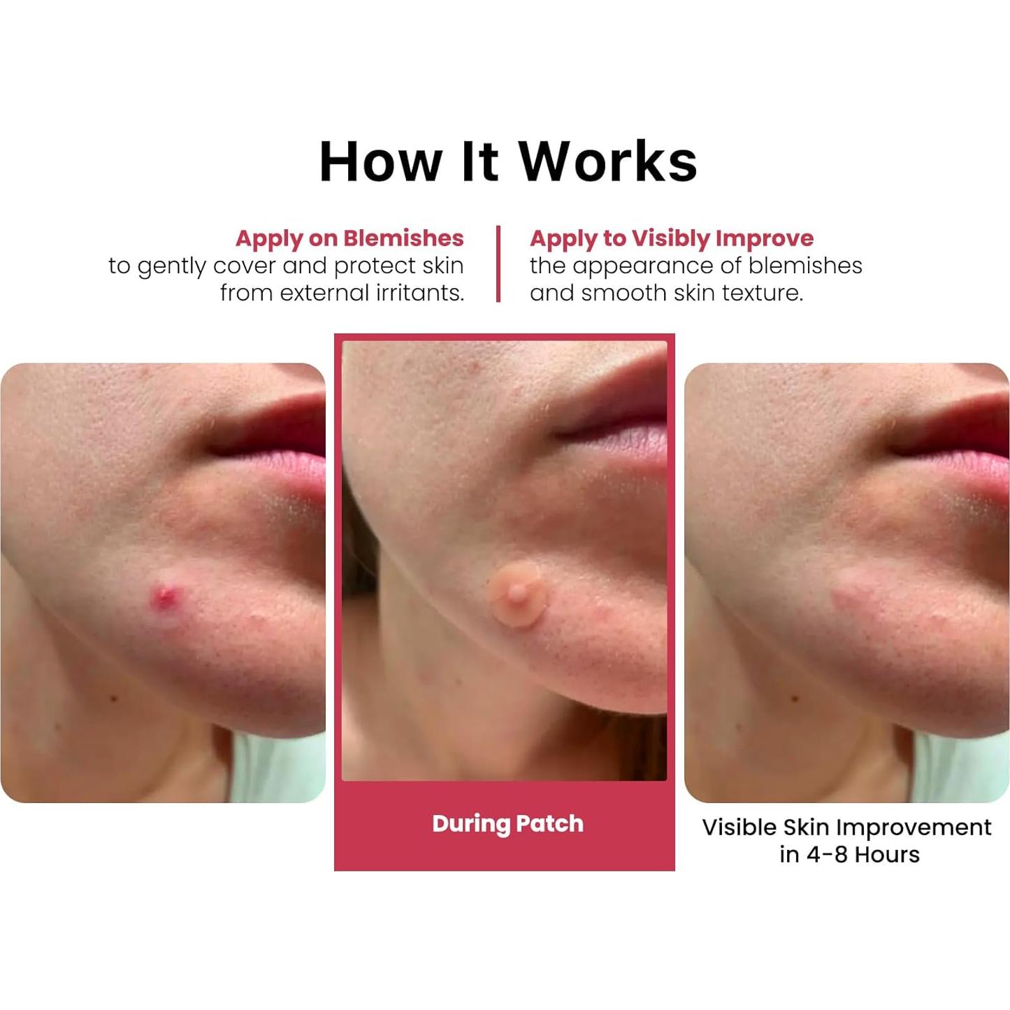 Parches Hidrocoloides para Acné RoselynBoutique - 60 Puntos