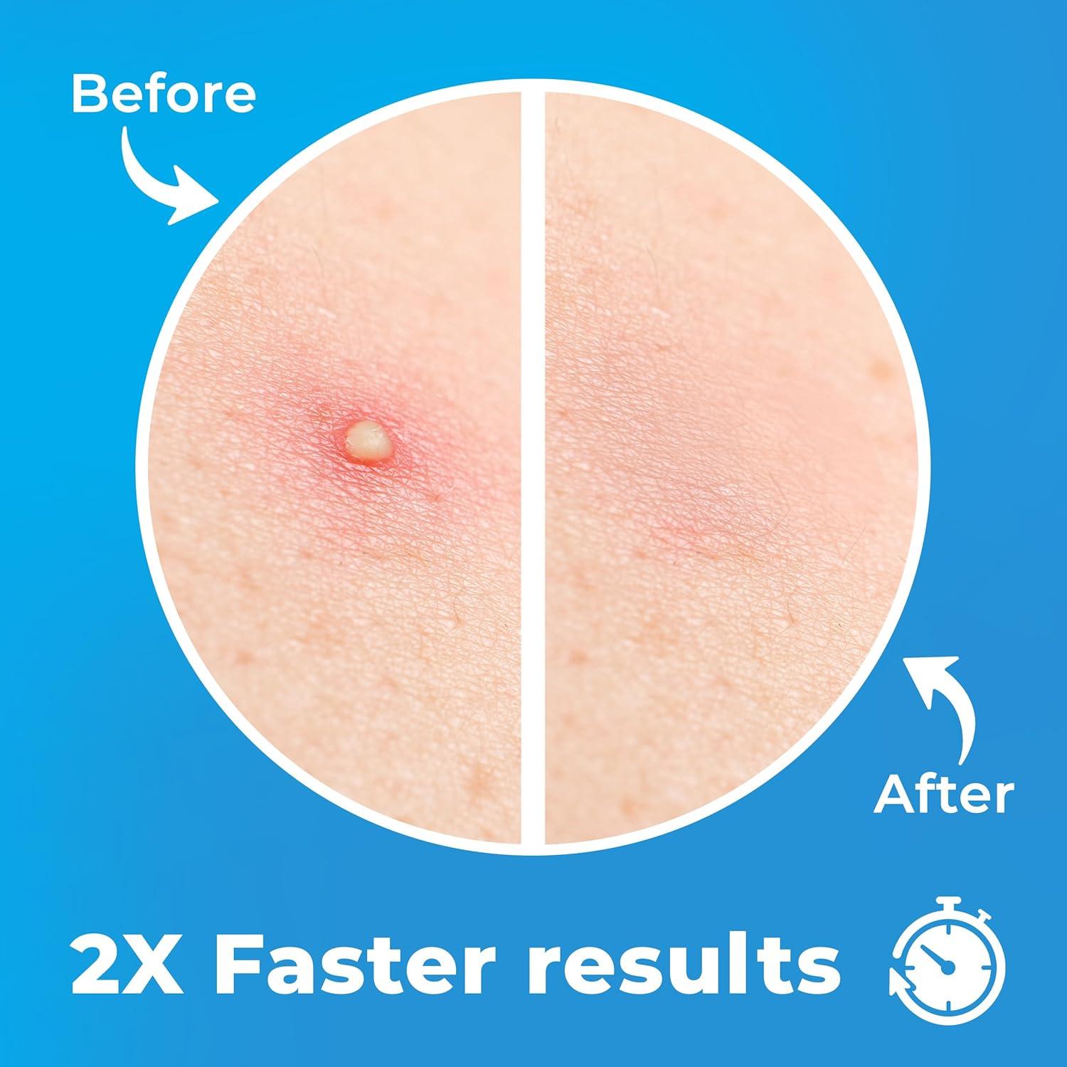 Parches para Granos Hydrocolloid PatchRx - 240 Unidades con Aceite de Árbol de Té