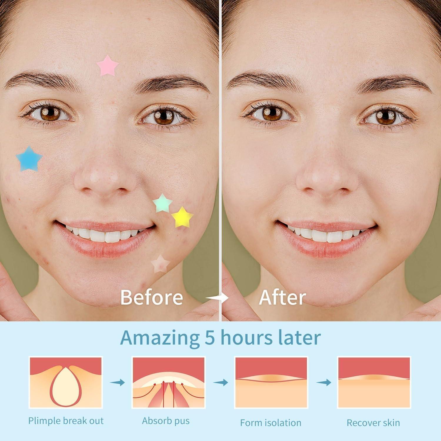 200 Parches Estrella para Acné Hidrocoloides REDANHA