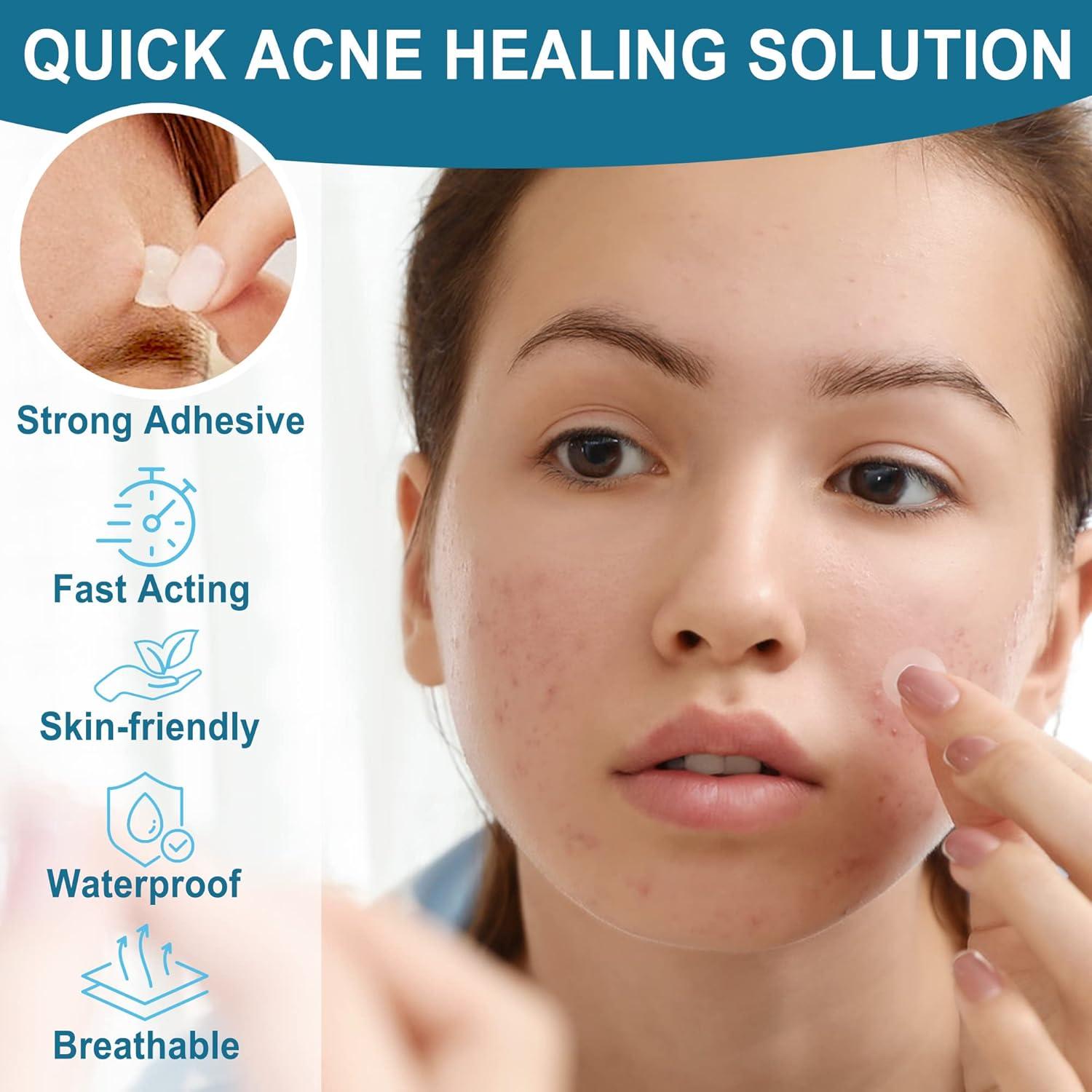 Parches para Acné LotFancy - 240 Unidades, 3 Tamaños (8, 10, 12mm)