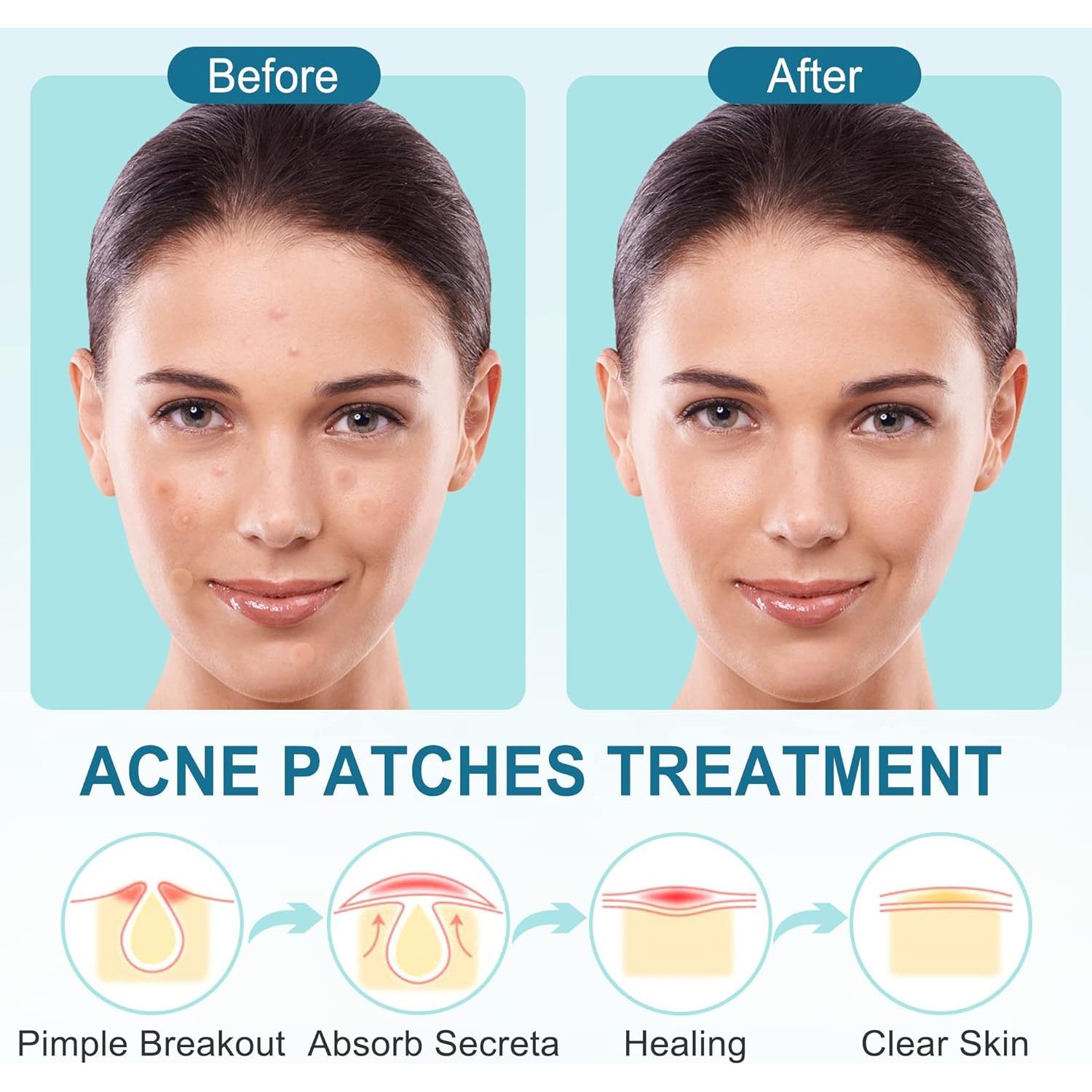 Parches para Acné LotFancy - 240 Unidades, 3 Tamaños (8, 10, 12mm)