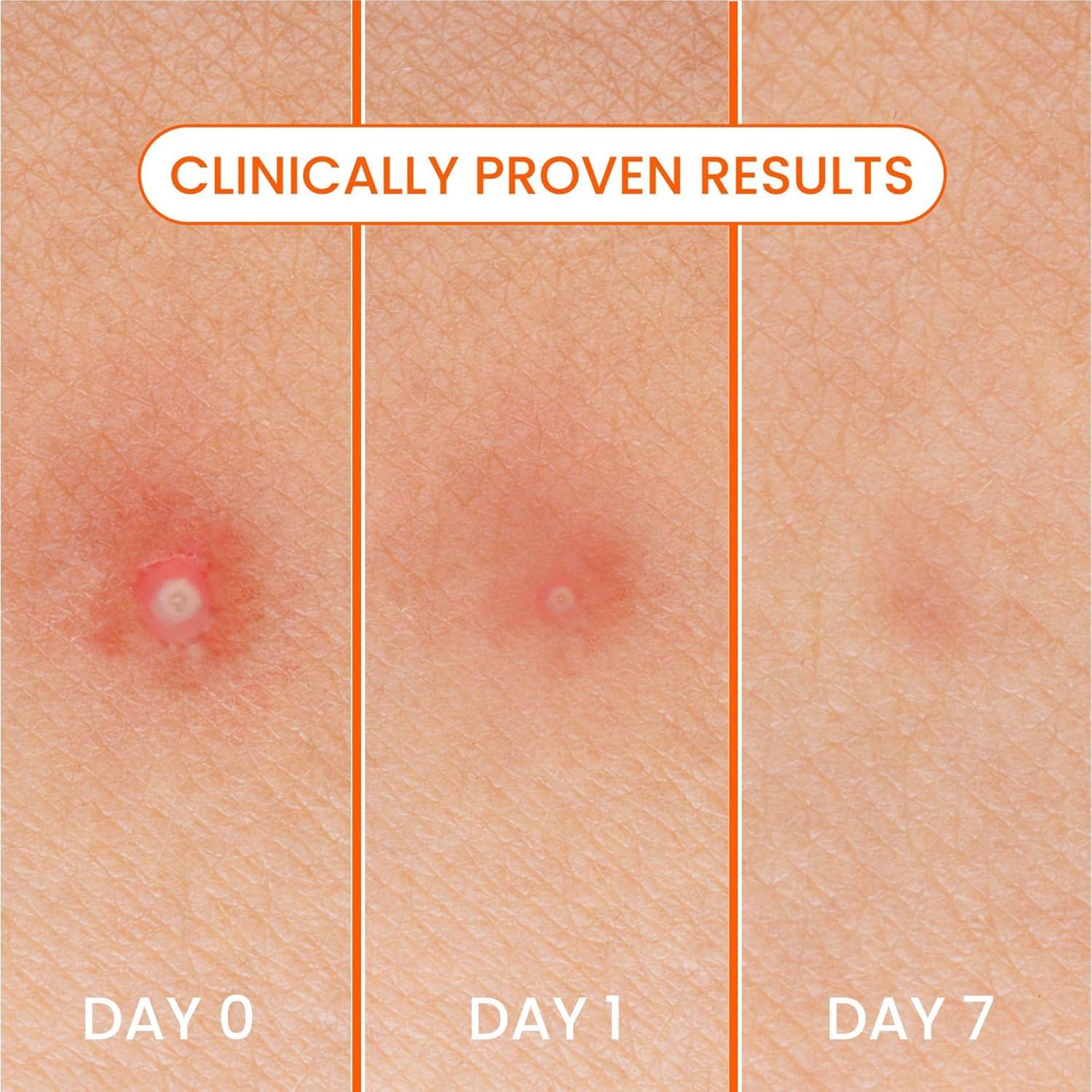 Parches para Granitos Biore 30 Unidades Hidrocoloide Grado Médico