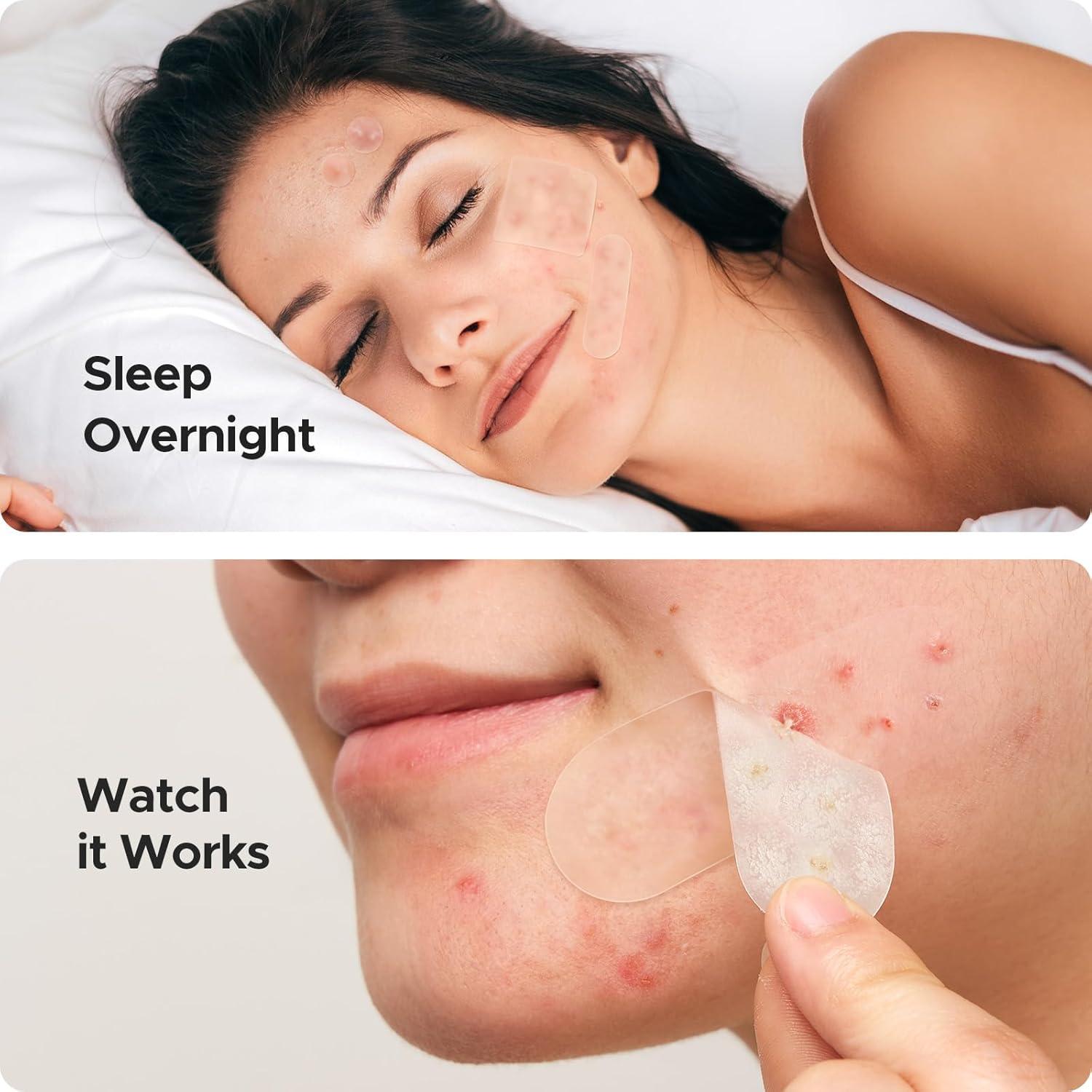 Parches Hidrocoloide TKTK 120 Unidades 45x45mm para Granitos