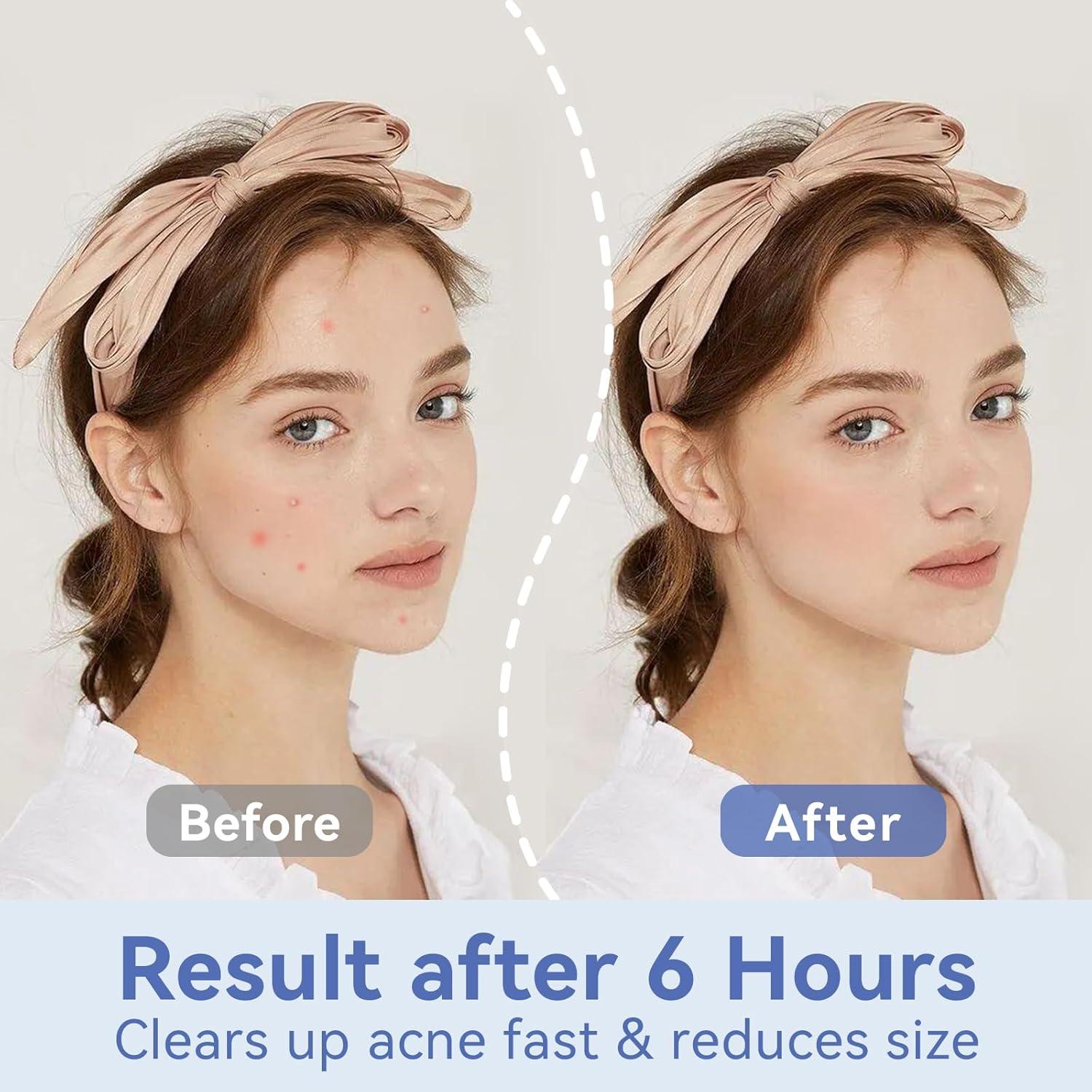 Parches Hidrocoloides para Granos Omadoto 12mm - 72 Unidades