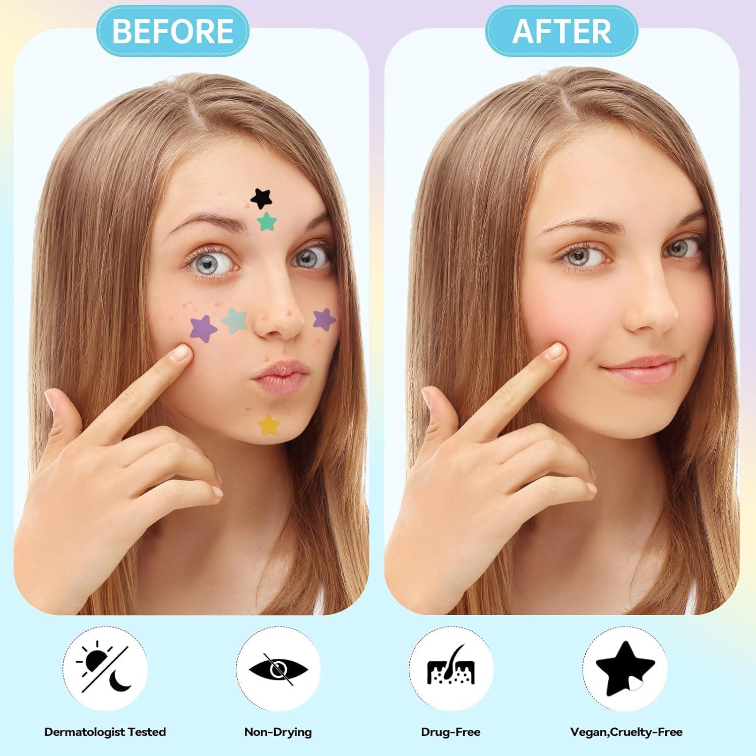 Parche para Granos Estrella Waspot - 240 Unidades Hidrocoloide