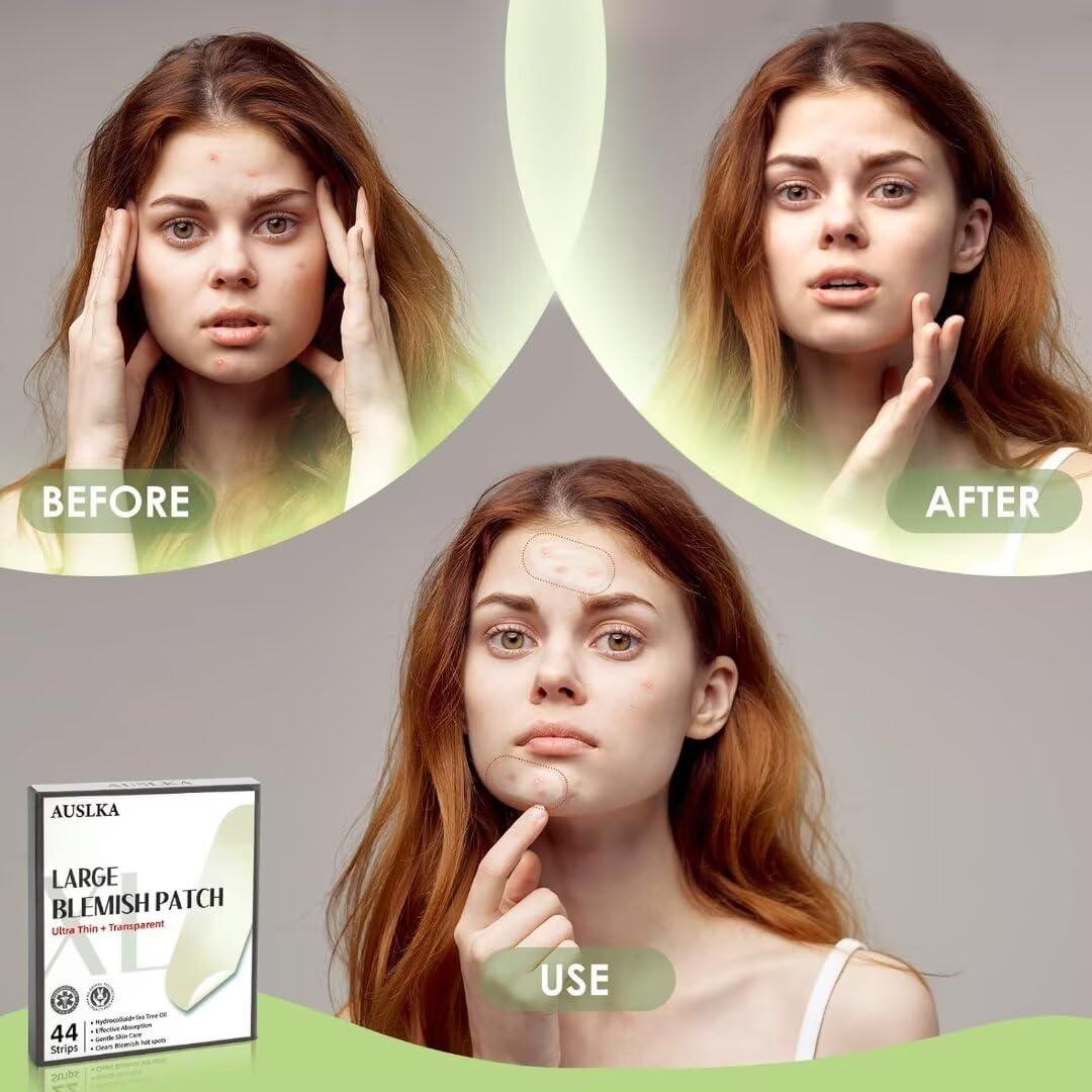 Parches Hidrocoloides AUSLKA para Imperfecciones - 44 Tiras XL