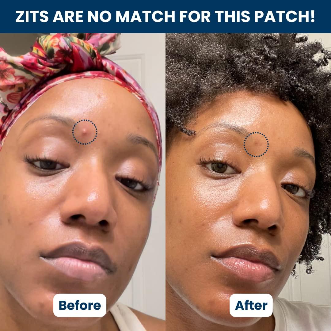 Parches Veganos Invisibles CLEAN SKIN CLUB para Espinillas - 60 Unidades