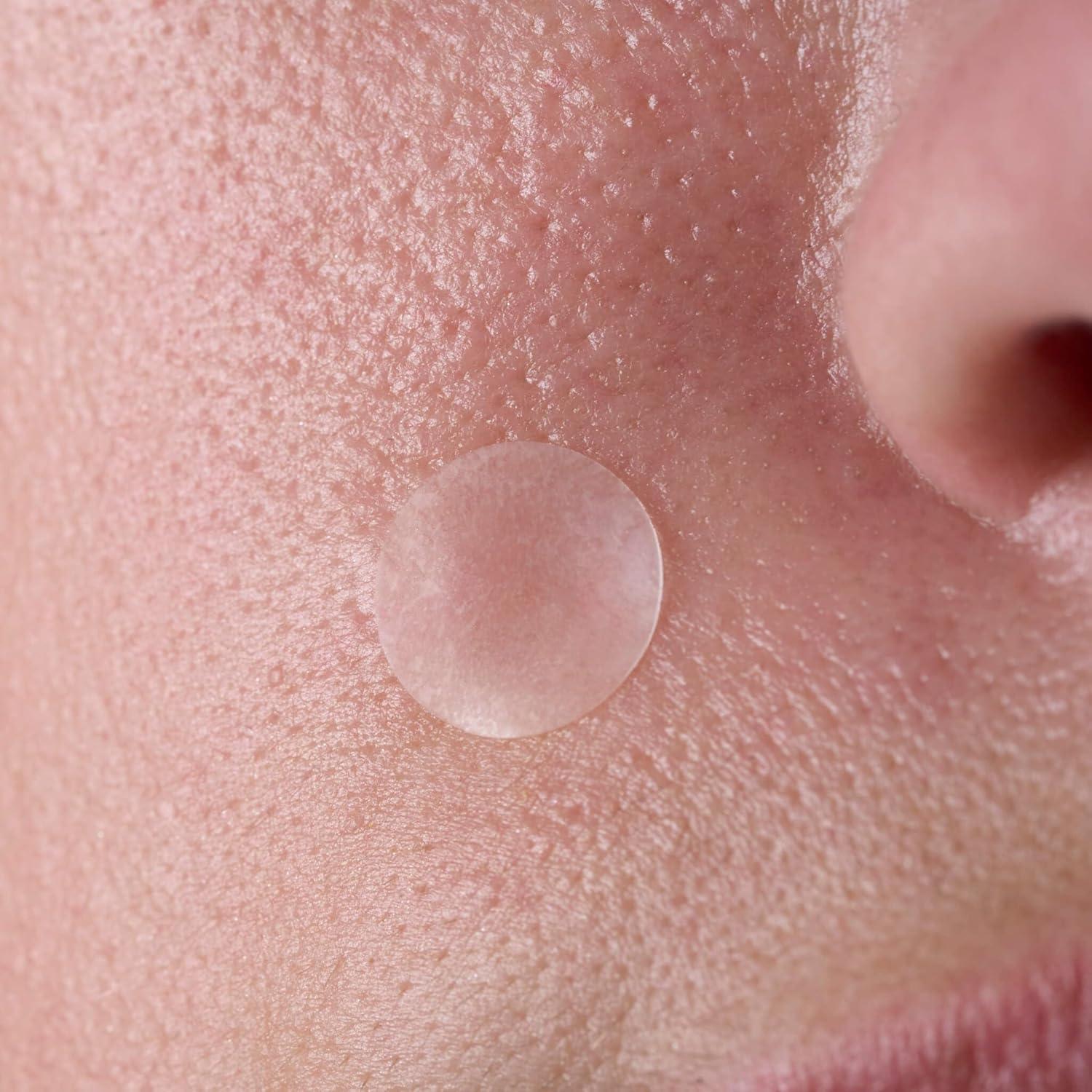 Parches Aclaradores Bliss Clear Genius - Ácido Salicílico y Zinc - 66 Unidades