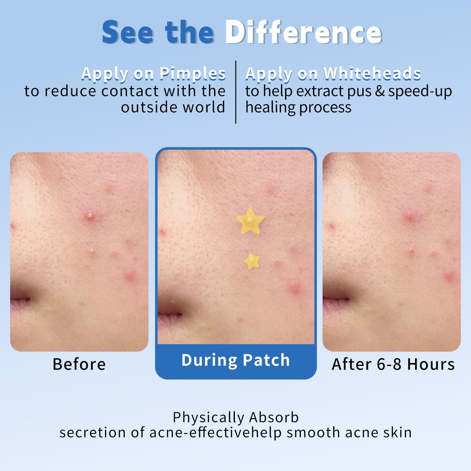 Parche Hidrocoloide para Granos Cabiuty - 200 Unidades, 3 Tamaños