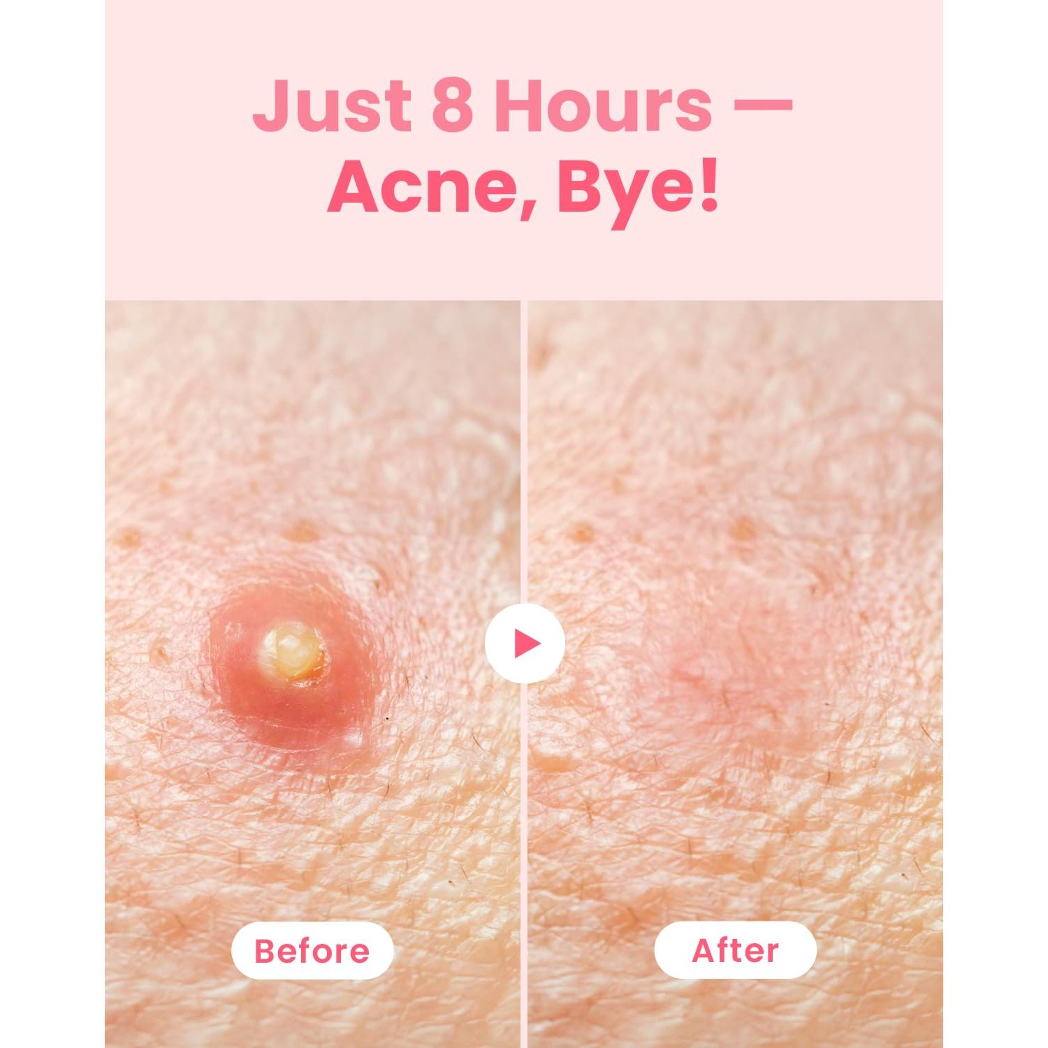 Parches Hidrocoloidales Glam Up 72 Unidades - Imperfecciones