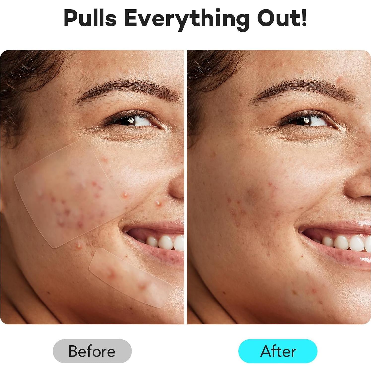 Parches para Granos LitBear - 118 Parches Hidrocoloide XL