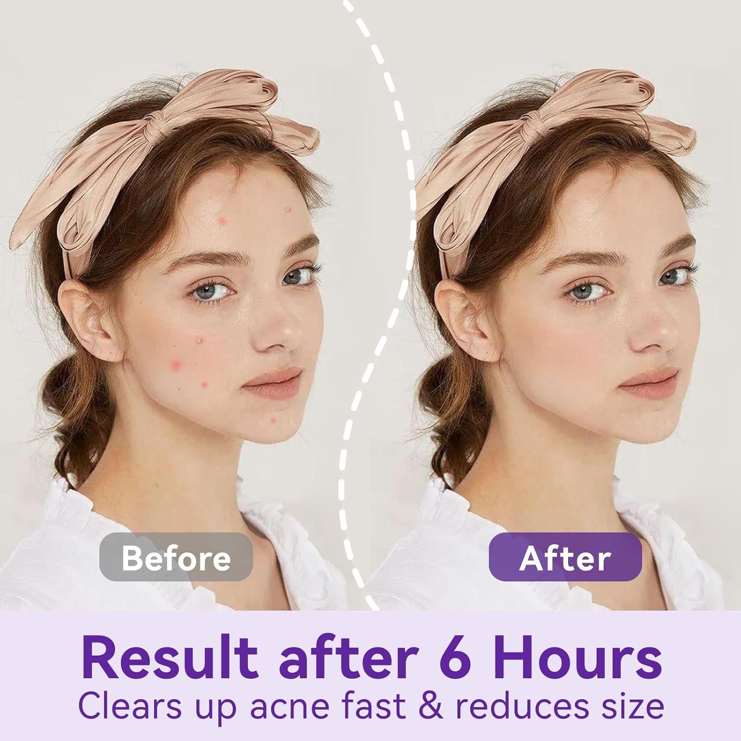 Parche Hidrocoloide para Granos Nocturno OmaDoto - 72 Piezas 10mm y 12mm