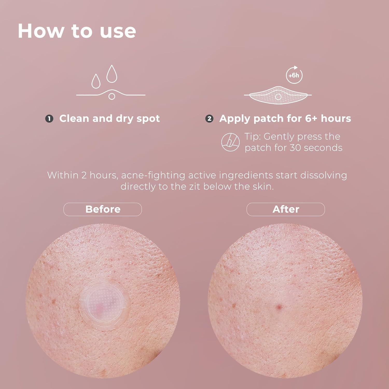 Parche de Acné Micropunto OMMA 14mm - Tratamiento Rápido