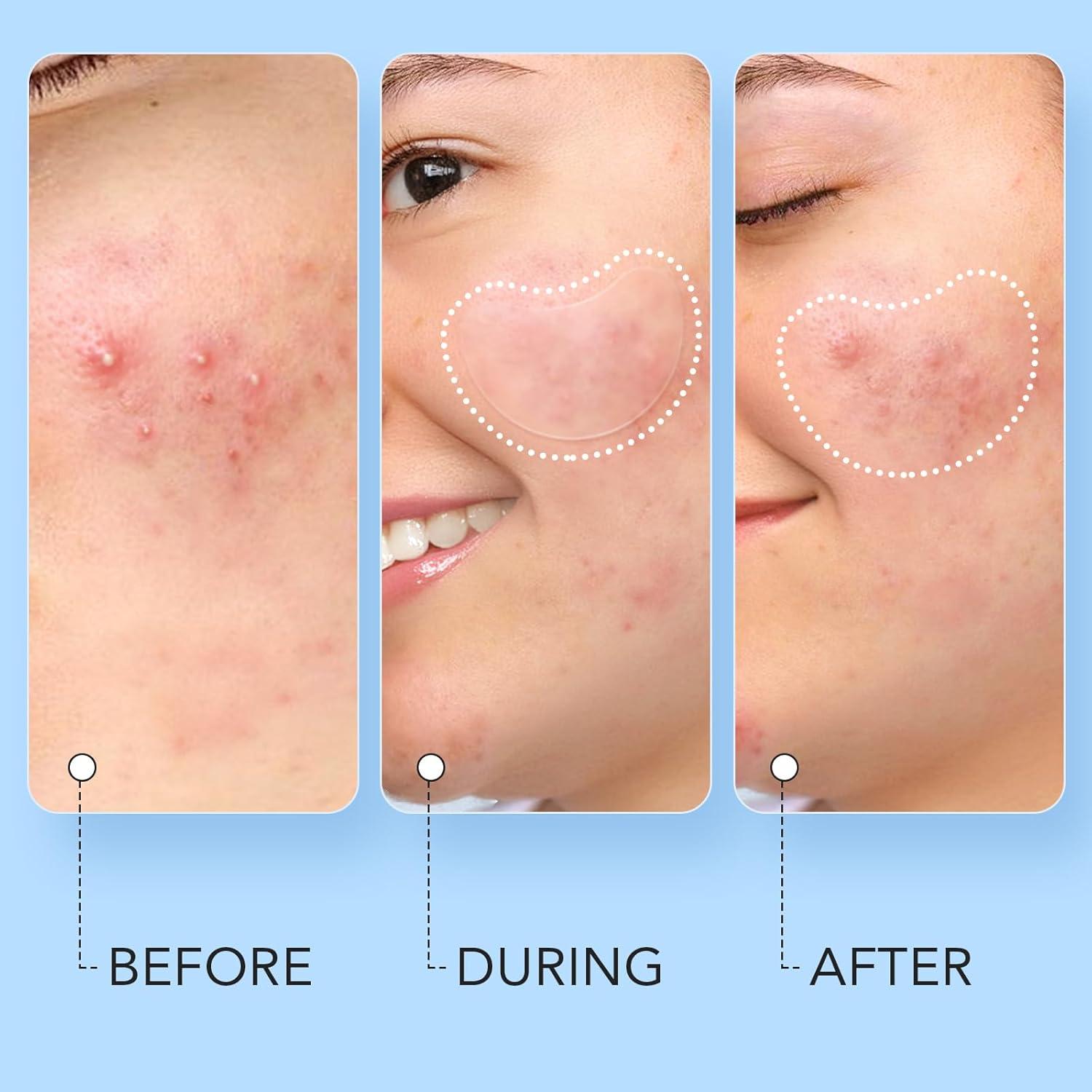 Parches Hidrocoloides para Acné LitBear - 140 Pcs, 8 Tamaños