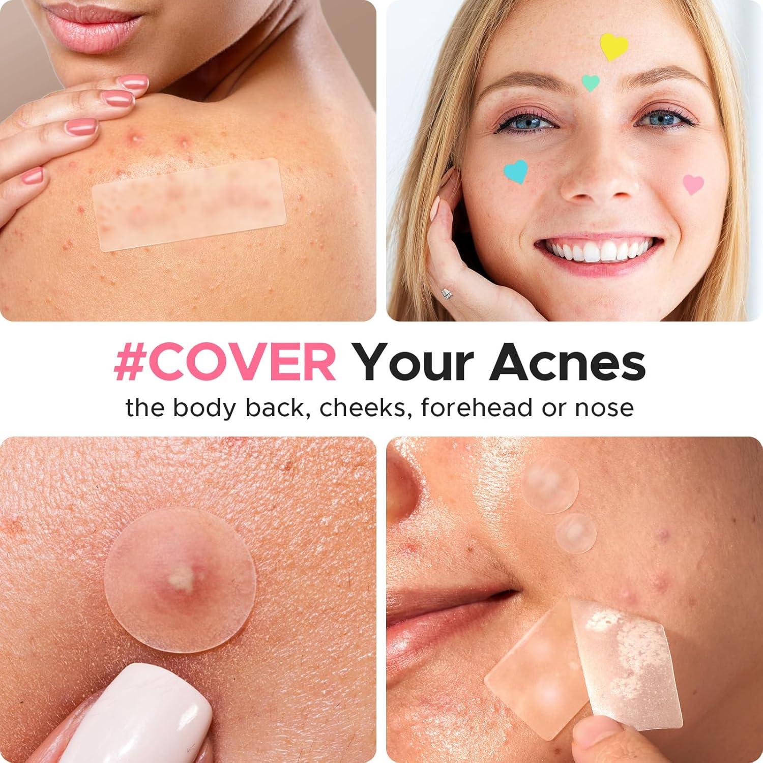 Parches Hidrocoloides para Acné LitBear 3 en 1 - 192 Piezas