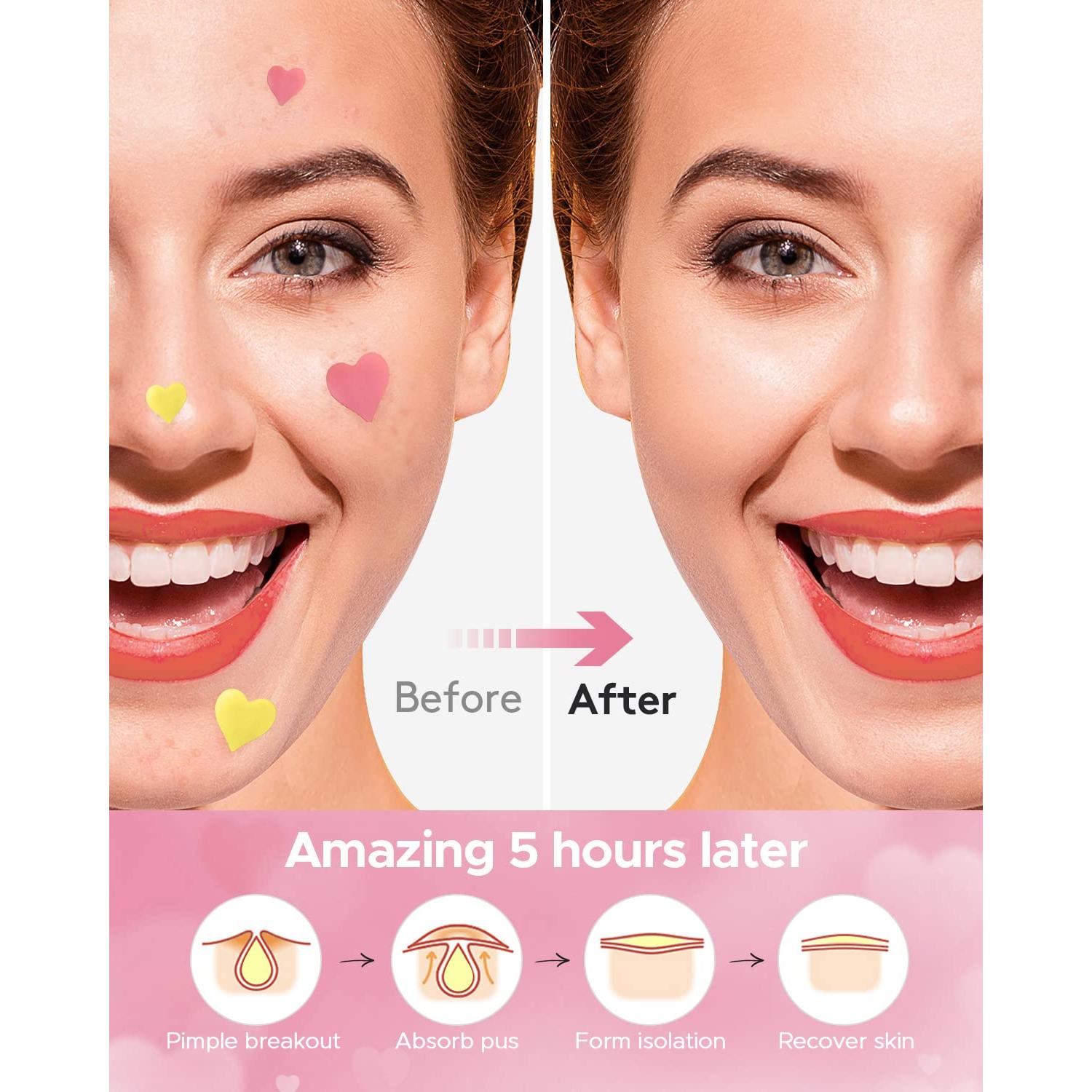 Parches Hidrocoloides para Acné LitBear 3 en 1 - 192 Piezas