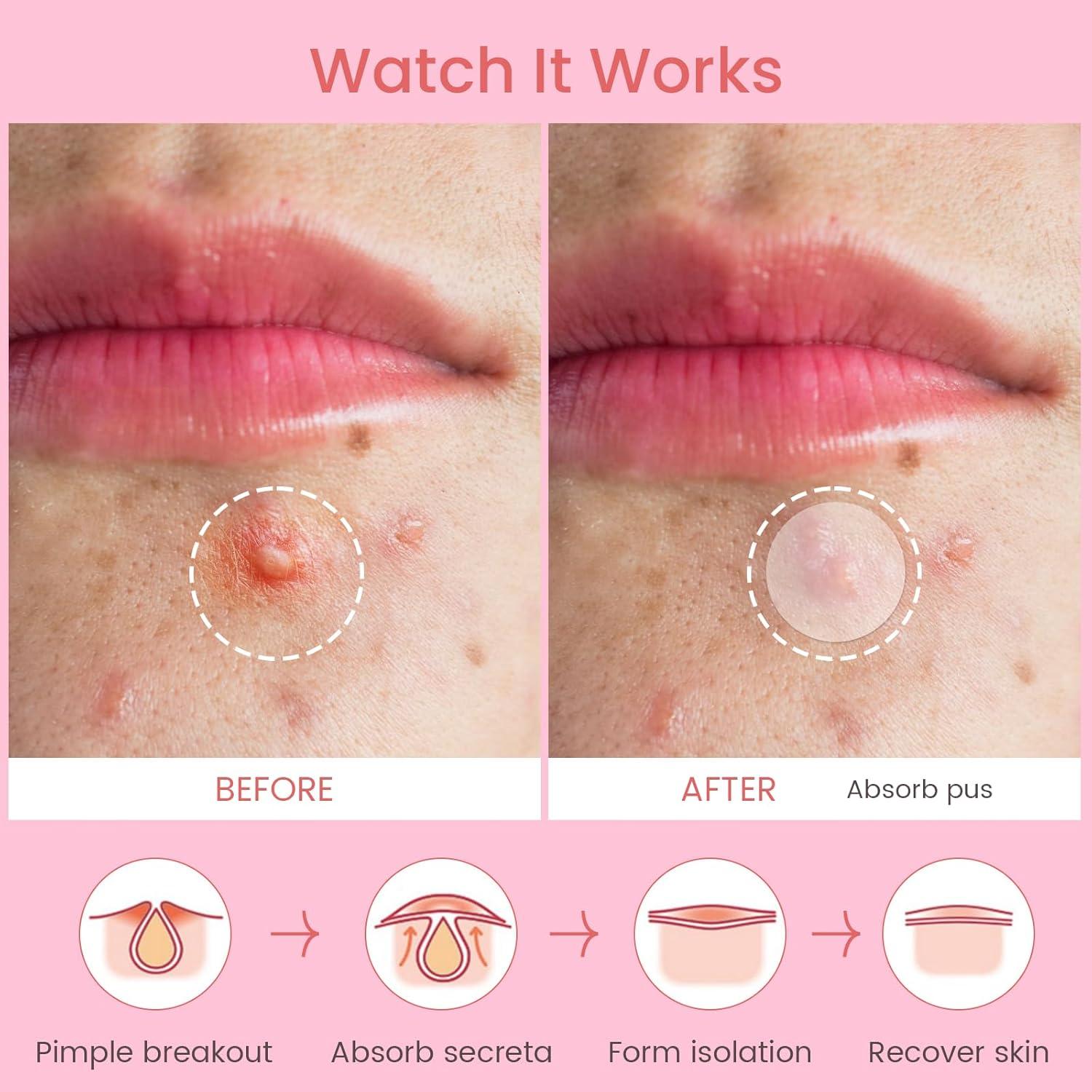 Parches para Granitos AUSLKA - 720 Parches Hidrocoloides