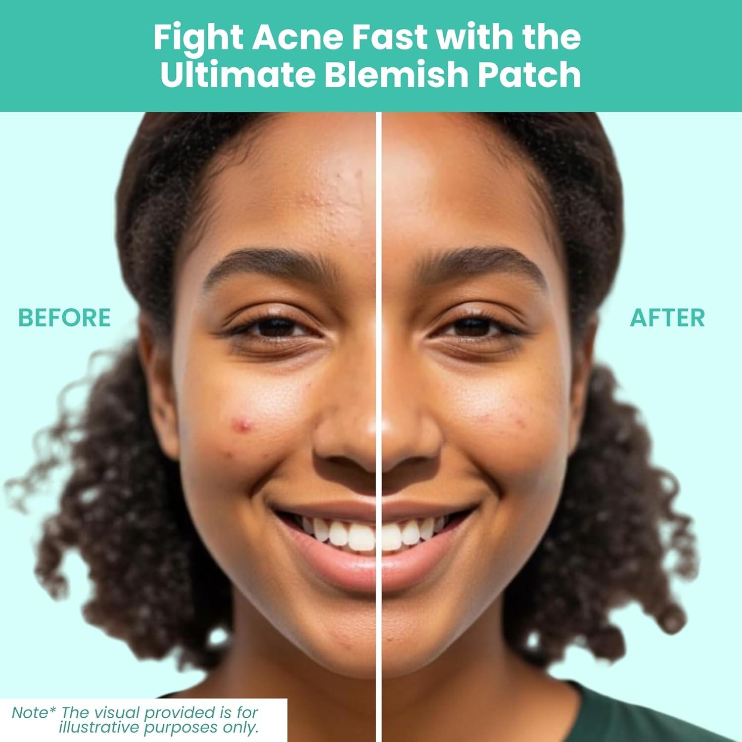 Kit de Tratamiento de Acné Patchology Breakout Box 3-en-1