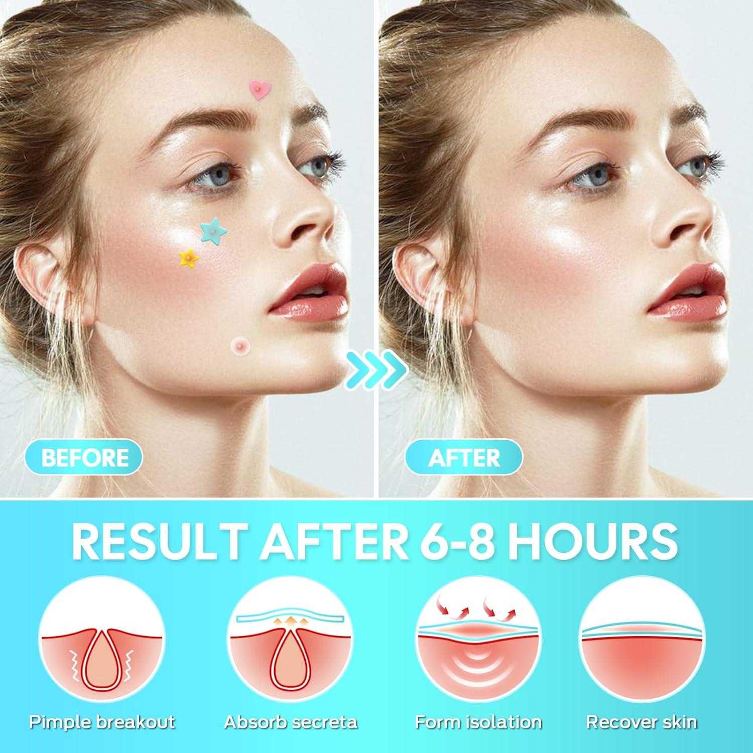 Parche Hidrocoloide para Granos VivaciousVision 306 Unidades