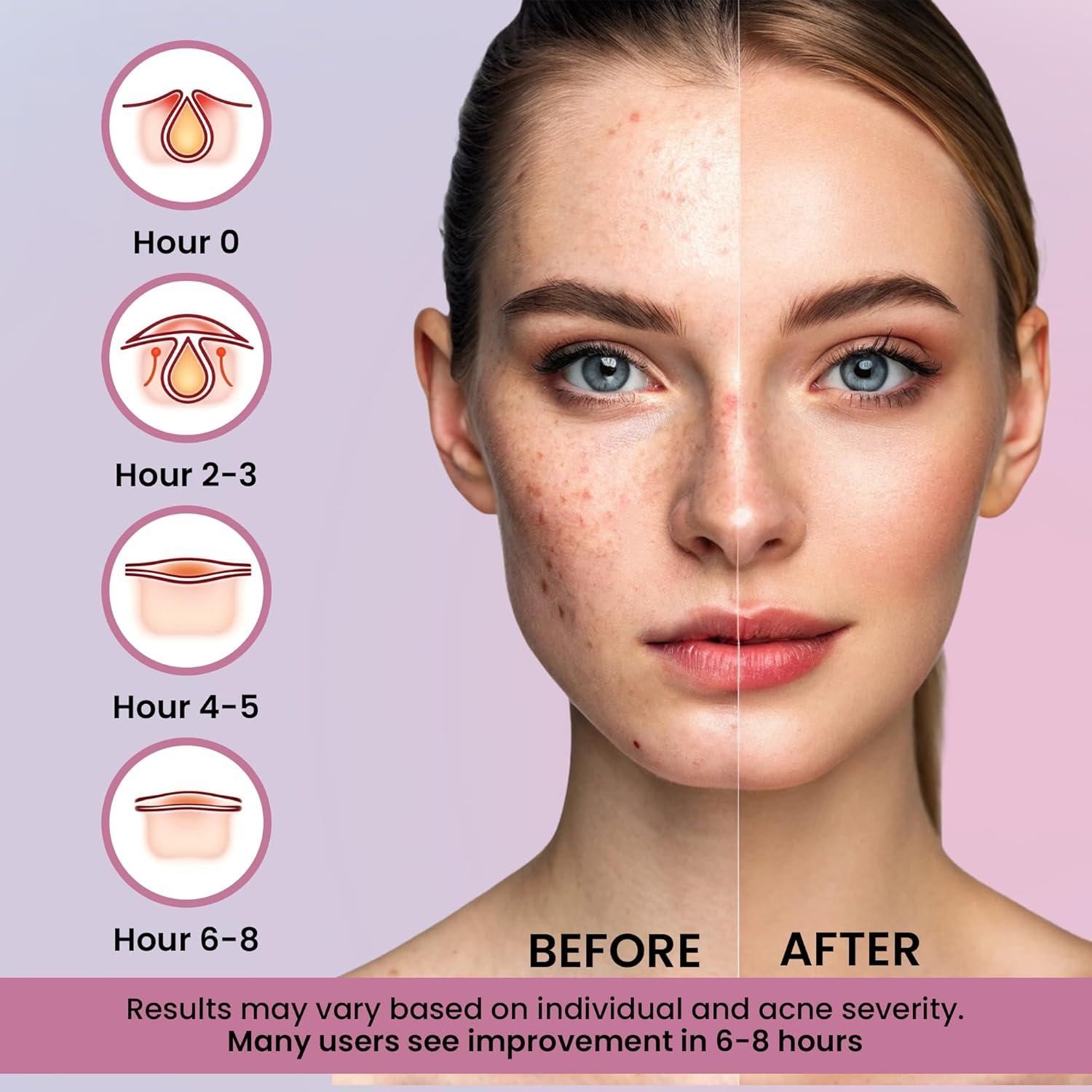 260 Parches Hidrocoloides para Espinillas Andlane - 7 Colores y 2 Tamaños