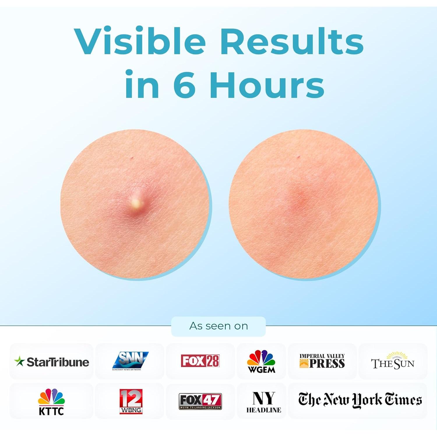 Parche Hidrocoloide para Acné CLEOF - 46 Unidades Vegano