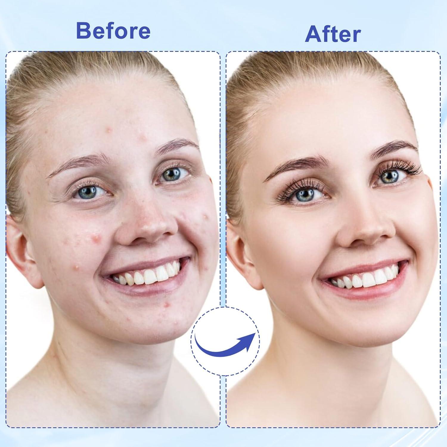 Parche Hidrocoloide para Granos CACRTY - 288 Piezas, Aceite de Árbol de Té