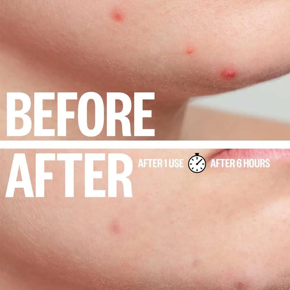 Parche Hidrocoloide para Acné Adarna Essentials 180 unidades