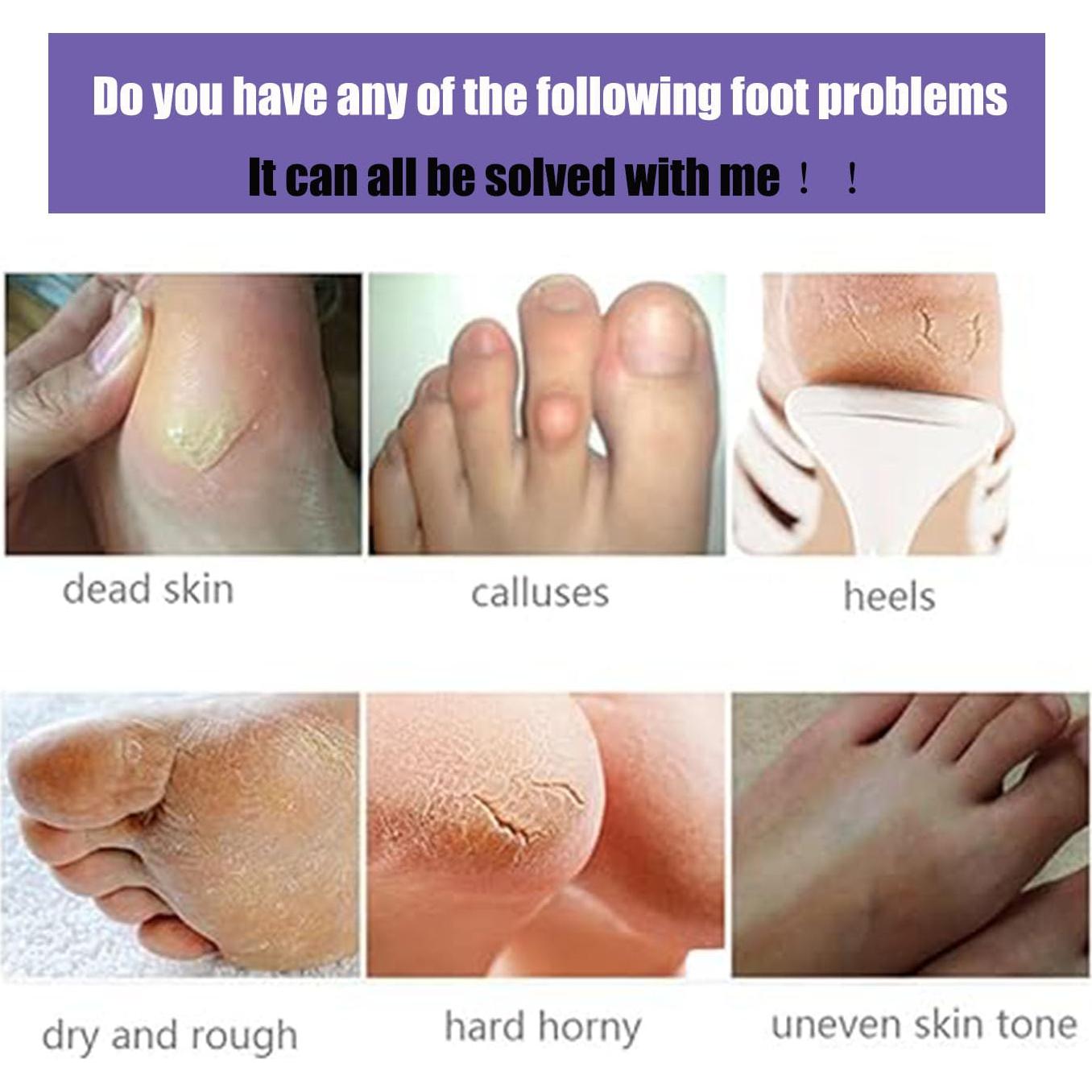 Mascarilla Exfoliante para Pies Mckkymi - 5 Paquetes Aroma Lavanda