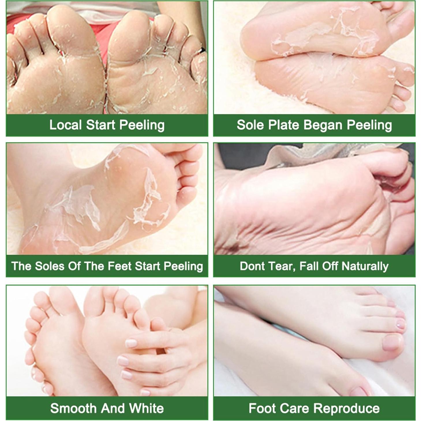 Mascarilla Exfoliante para Pies Newh3c - 5 Paquetes, Talones Suaves