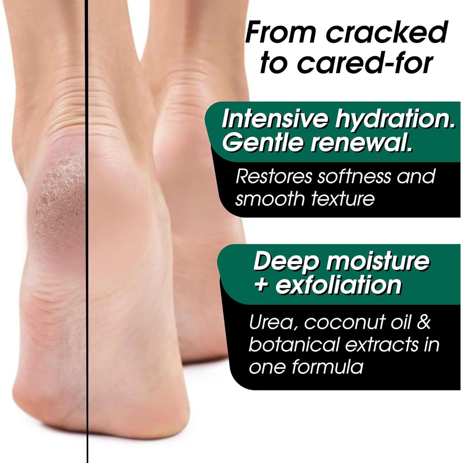 Urea Cream 40 Percent – Foot Cream for Dry Cracked Heels & Feet, Foot Balm Moisturizer Lotion for Extremely Dry Skin, Athletes Foot Cream Maximum Strength, Dry Feet & Hands Treatment for Women & Men