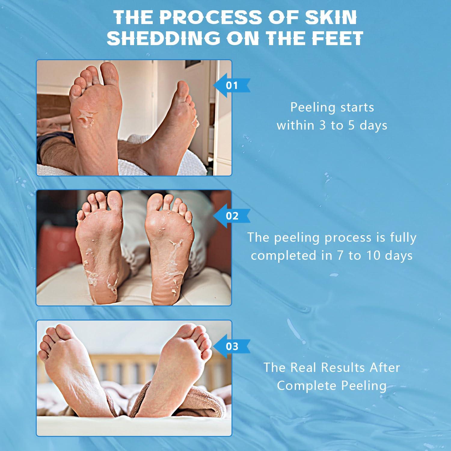 Mascarilla Exfoliante para Pies YOUNGYOUNGLOVE 3 Paquetes 40% Urea