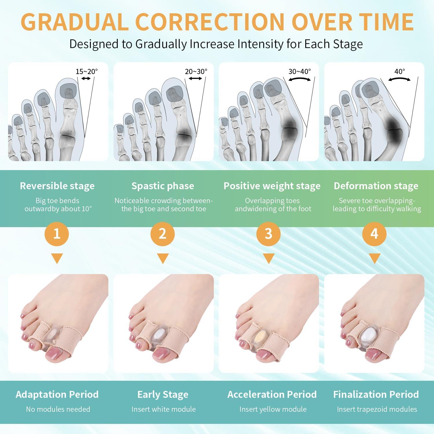 Separadores de Dedos de Gel Pitoyteck para Juanetes - Ajustables