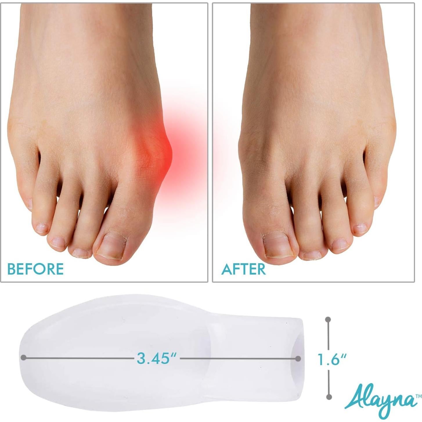 Separadores de Dedos Alayna Corrector de Juanetes Gel 2 Pcs