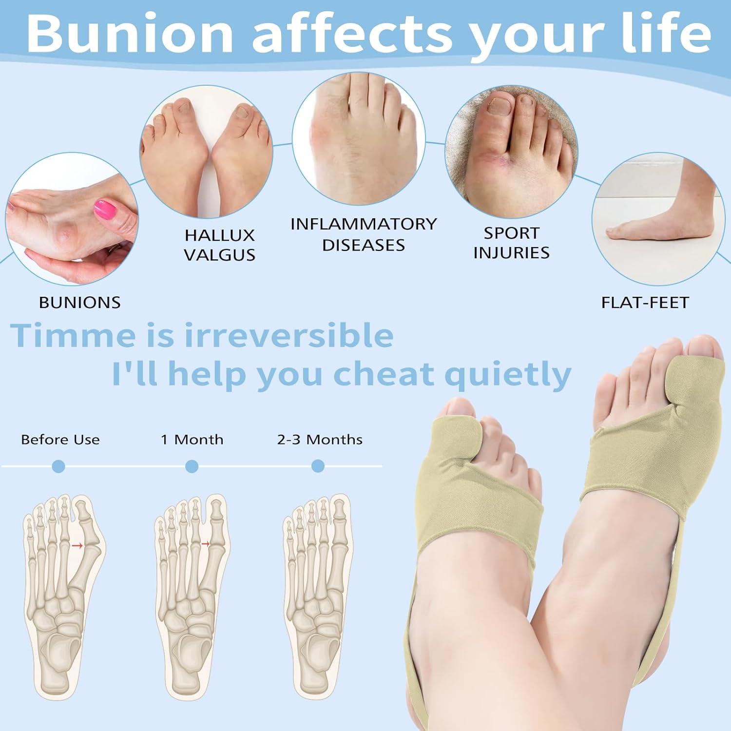 Corrector de juanetes ZORVOKE para hombres y mujeres - Alivio del dolor - 2 piezas beige