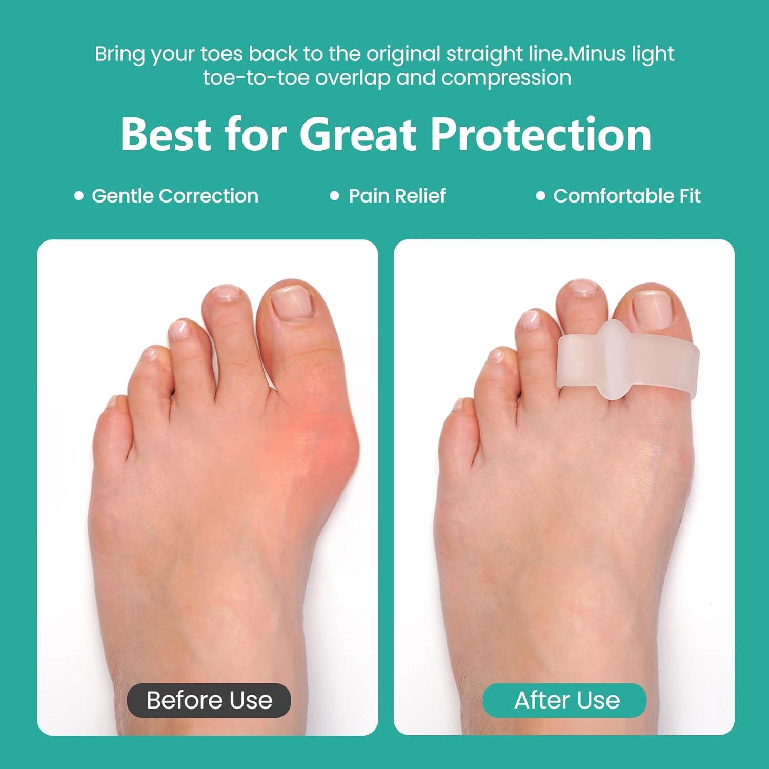 Welnove Paquete de 12 Correctores de Juanetes y Separadores de Dedos