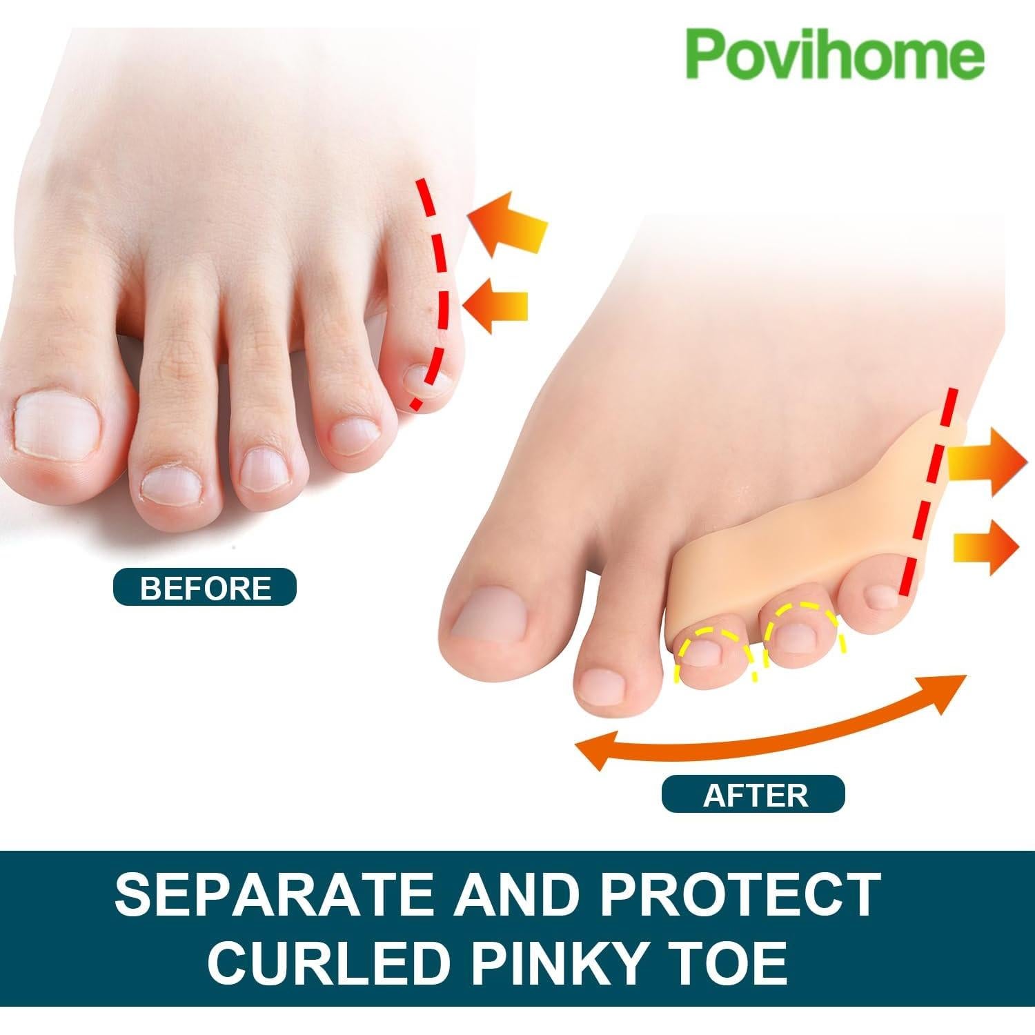 Separadores de Dedo Meñique Povihome - Alivio Neuroma 10 Piezas