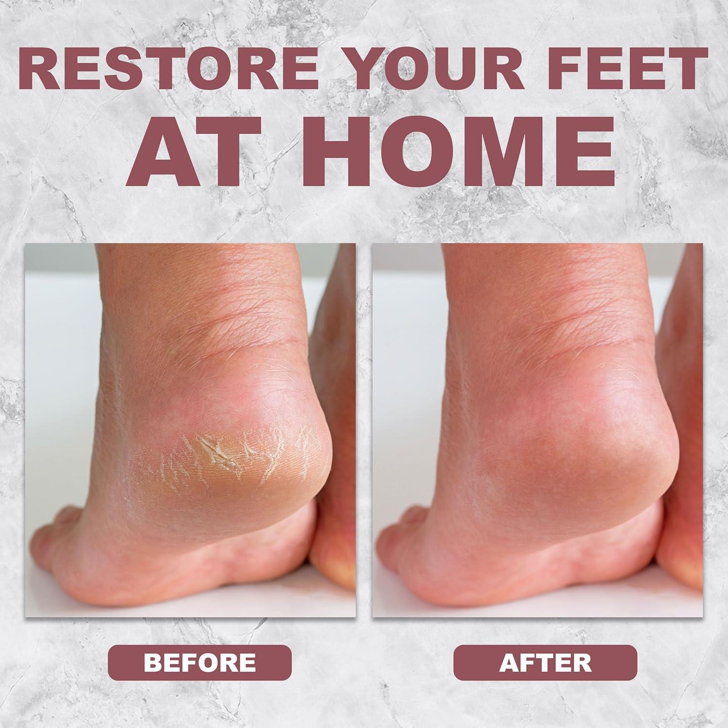 Removedor de Callos MHB Rosa - Lima Profesional para Pies