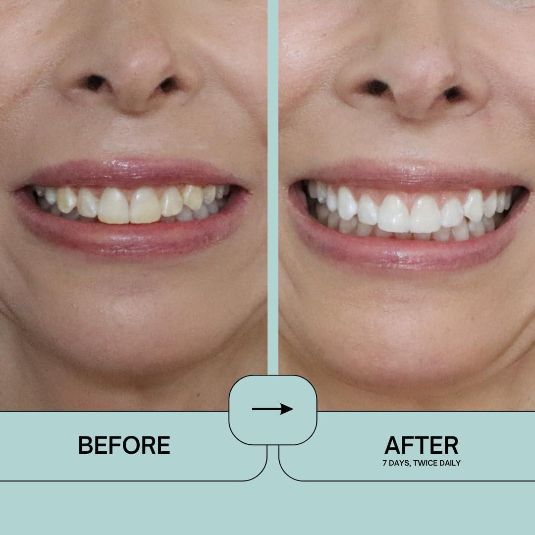 Prostrips - 28 Tiras Blanqueadoras Dentales - 12 Tonos Más Blancos