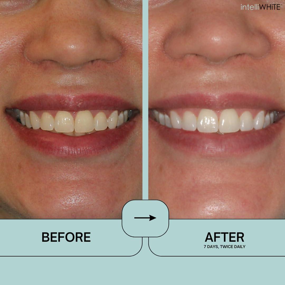 Prostrips - 28 Tiras Blanqueadoras Dentales - 12 Tonos Más Blancos