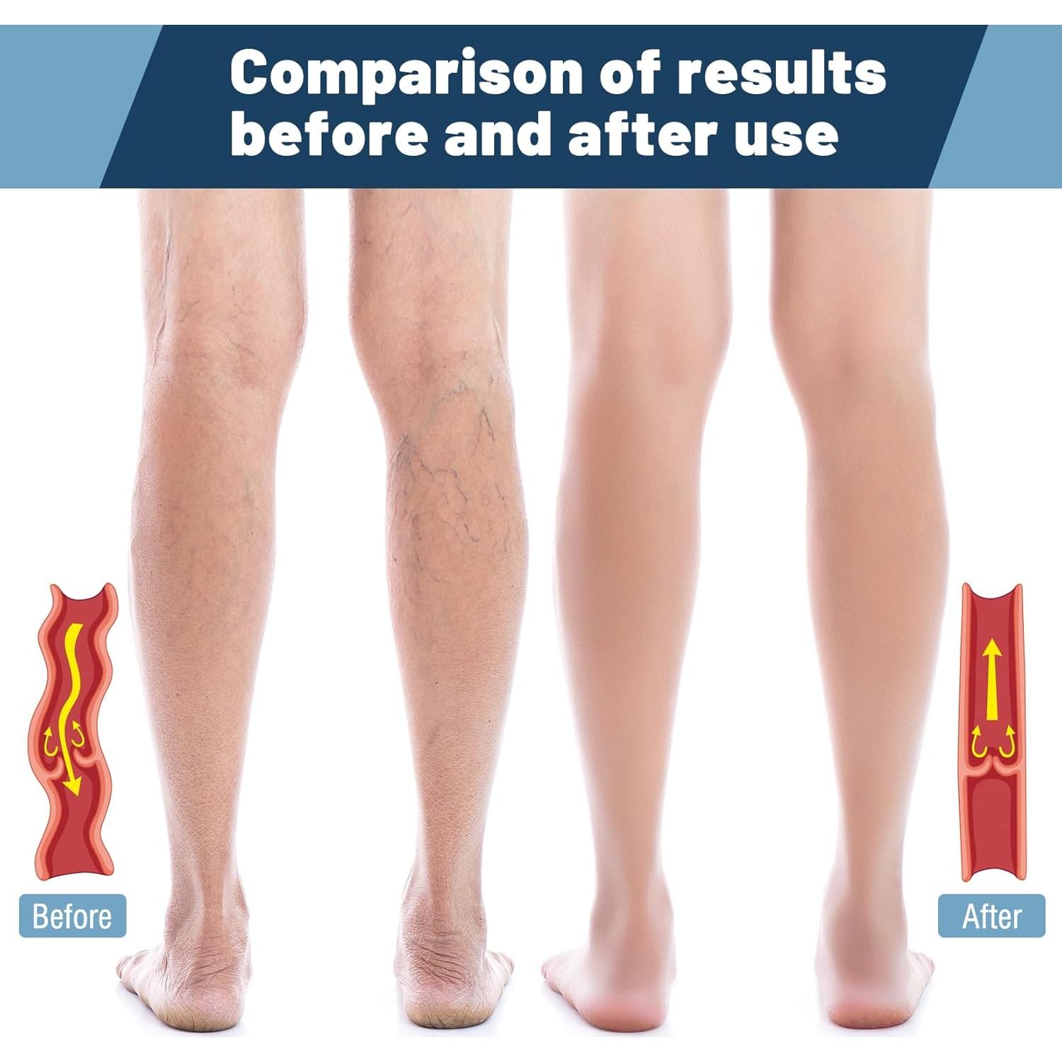 Calcetines de Compresión AKSO MEDICOS 20-30 mmHg Talla 4XL Beige