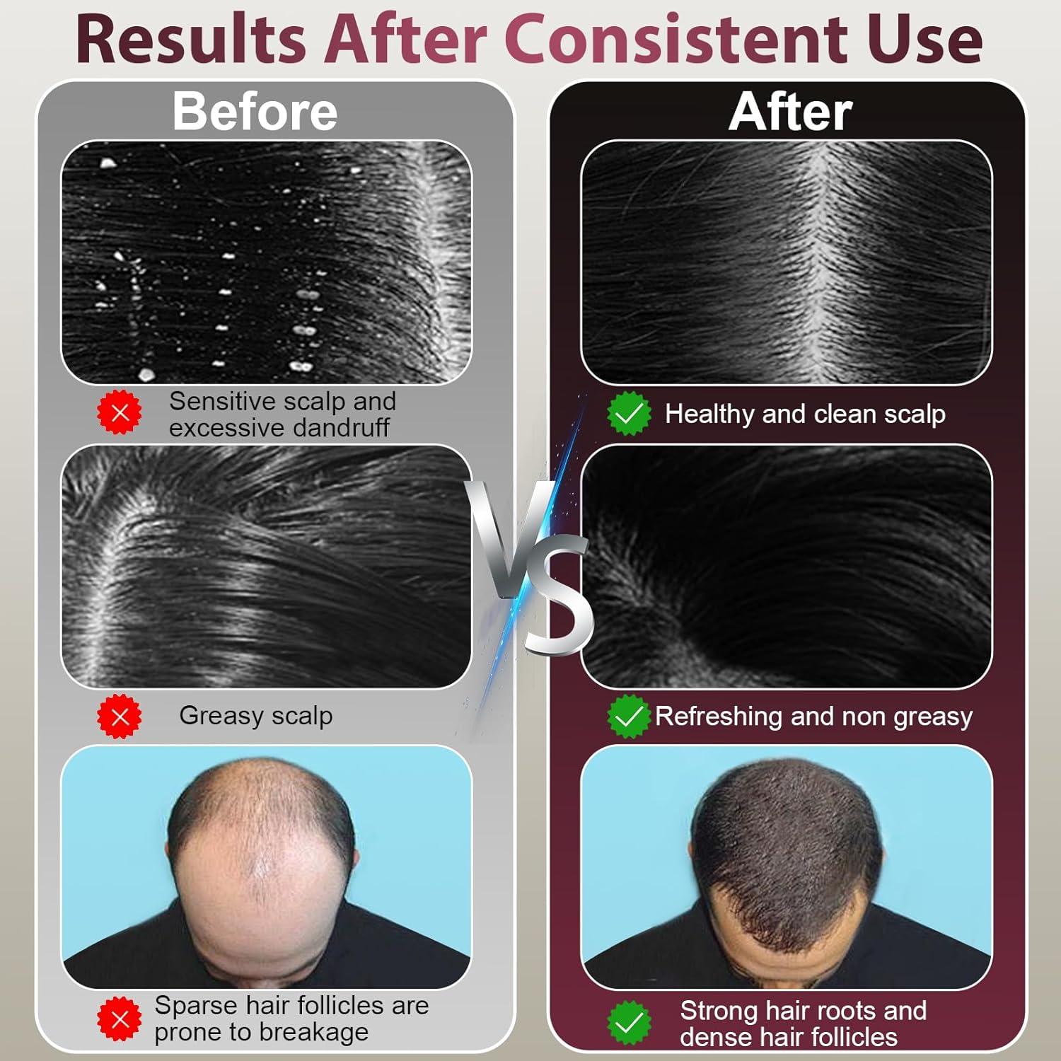 Peine Terapia Láser Crecimiento Capilar IPX7 - Lasercomb-001