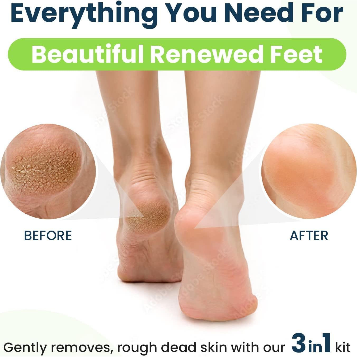 Removedor de Callos para Pies Foot Cure - Gel y Piedra Pómez