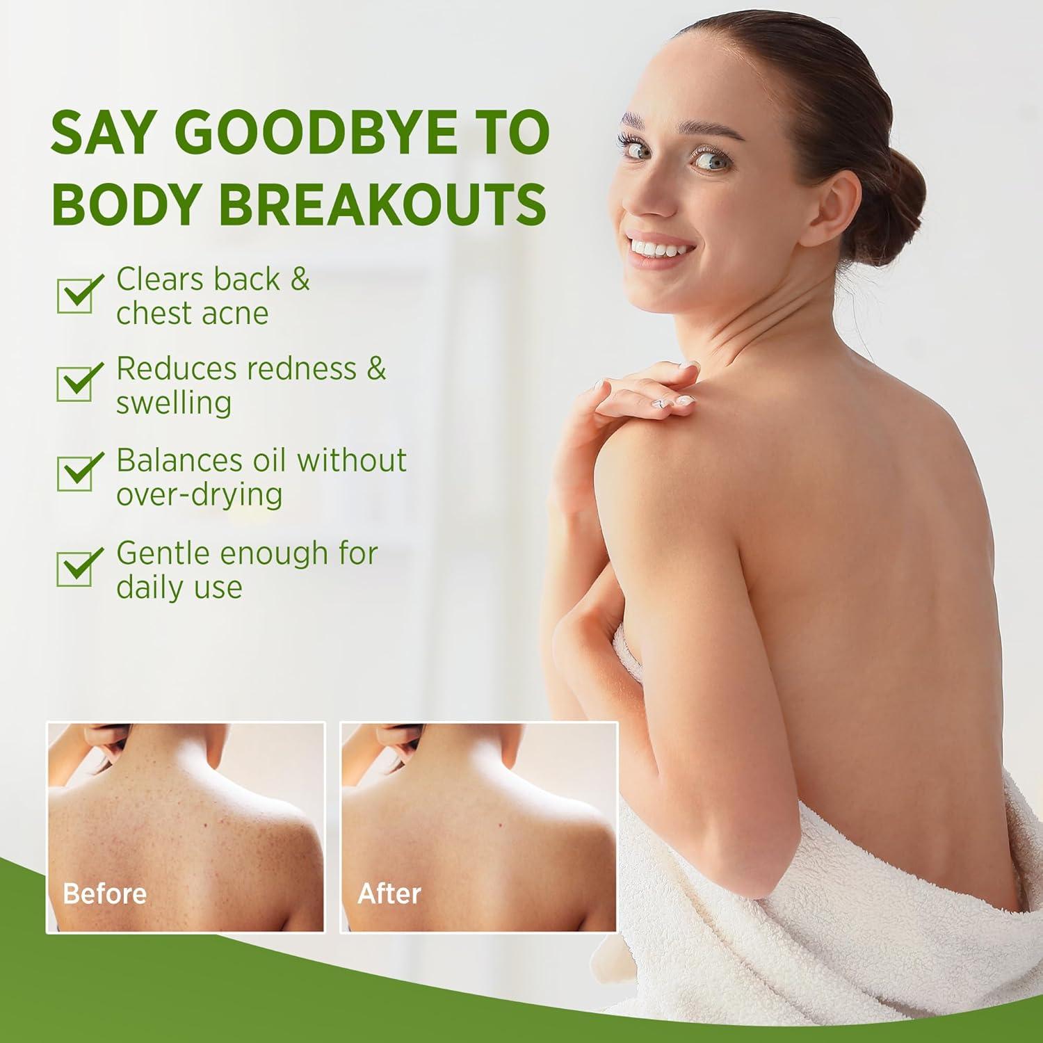 Jabón Antifúngico Antibacteriano Roycederm 226g Tea Tree