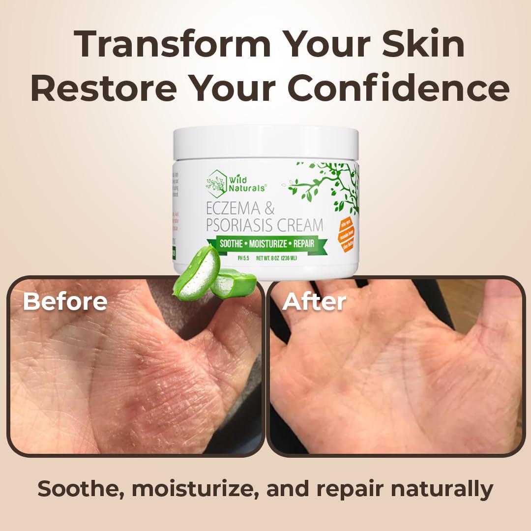 Crema Hidratante para Eczema y Psoriasis Wild Naturals 113g