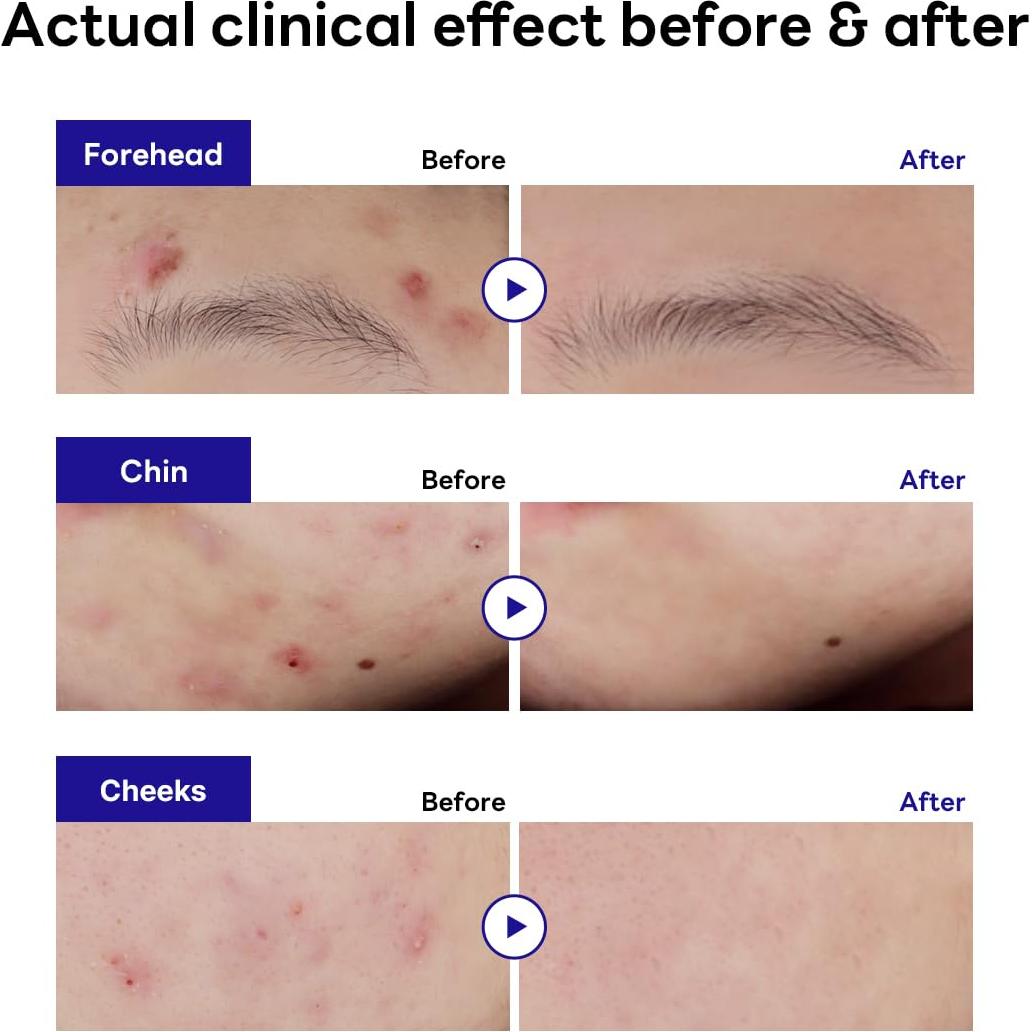 Mediheal Parche Antiacné Teatree 44 Unidades - Alivio y Equilibrio