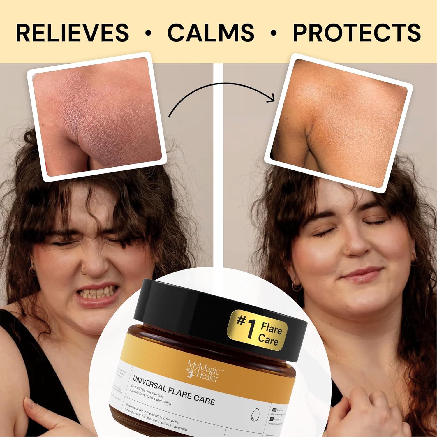 Cuidado Universal de Brotes MyMagicHealer 28.35g Alivio Eccema