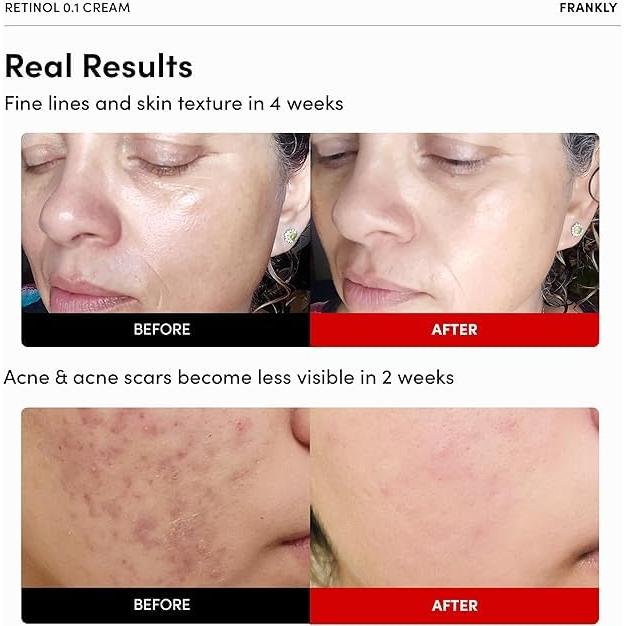 Crema de Retinol 0.1% Frankly 30 ml - Antienvejecimiento y Acné