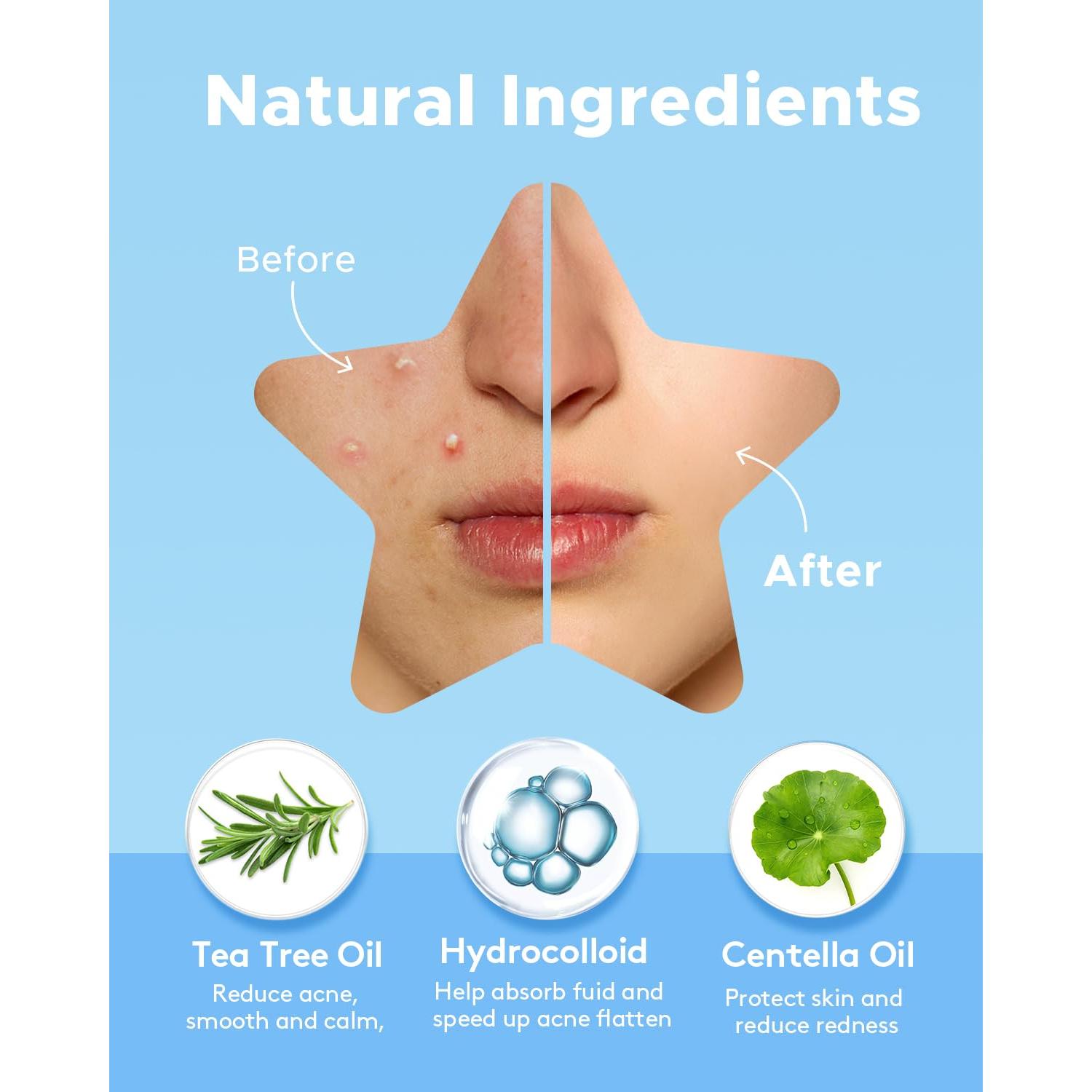 Parche Hidrocoloide para Acné LitBear - 6 Colores, 240 Puntos