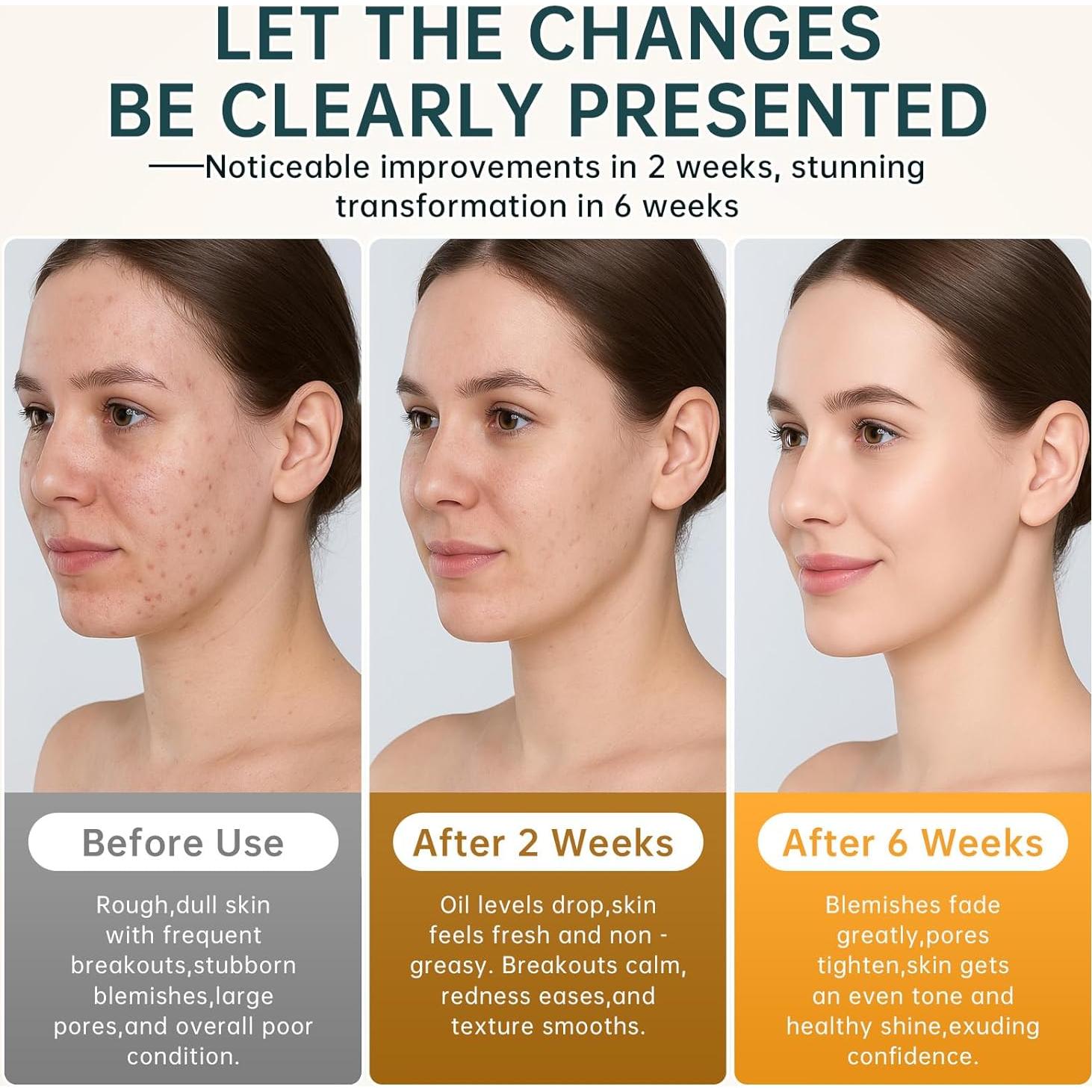 Crema para el Acné Bechoicen 14% Ácido Azelaico 28g