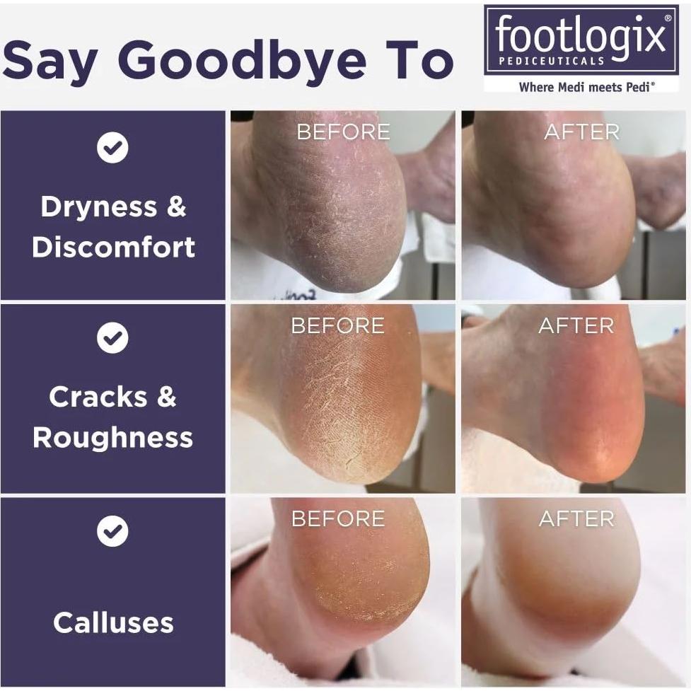 Suavizante de Callos Footlogix + Lima Doble Cara 1 Cuenta